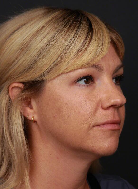 Contouring & Tightening Before & After Image