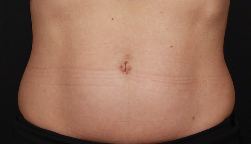 Contouring & Tightening Before & After Image