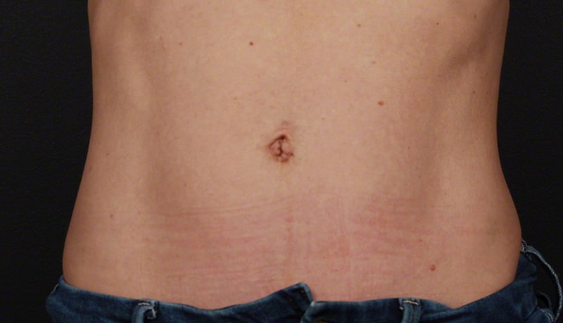 Contouring & Tightening Before & After Image