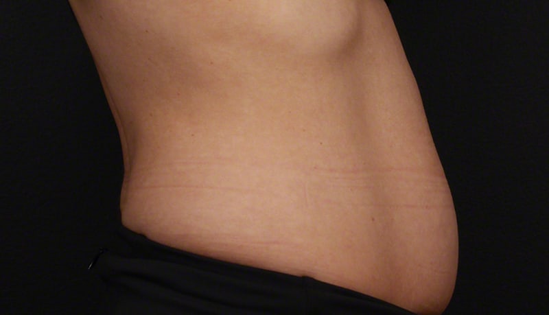 Contouring & Tightening Before & After Image