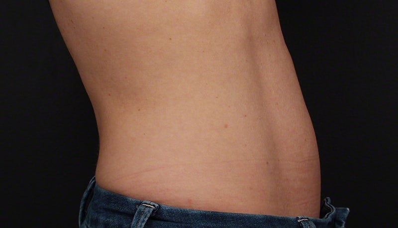 Contouring & Tightening Before & After Image