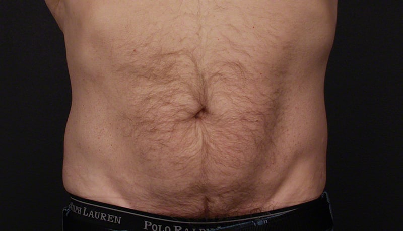 Contouring & Tightening Before & After Image