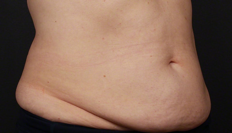 Contouring & Tightening Before & After Image