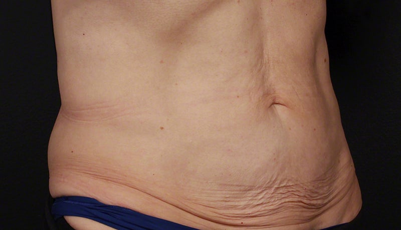 Contouring & Tightening Before & After Image