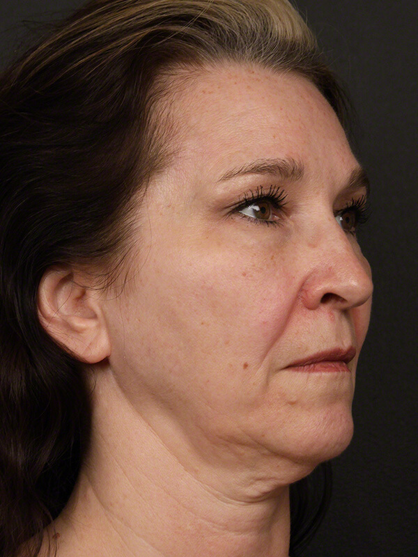 Contouring & Tightening Before & After Image