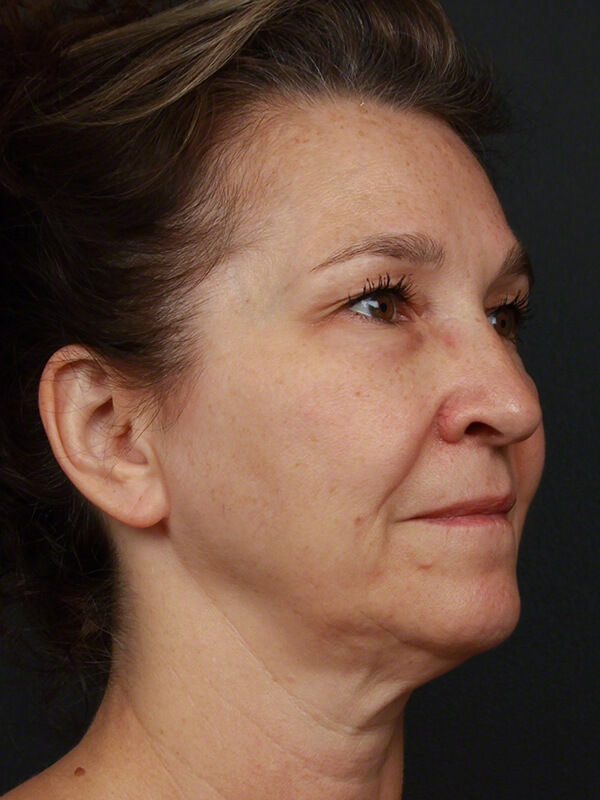 Contouring & Tightening Before & After Image