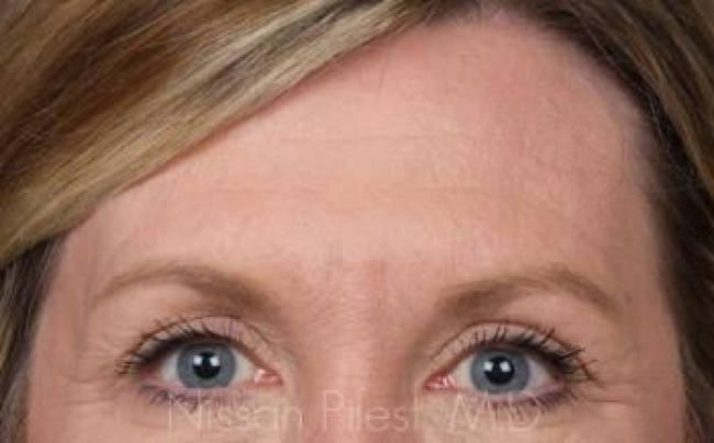 Injectables Before & After Image