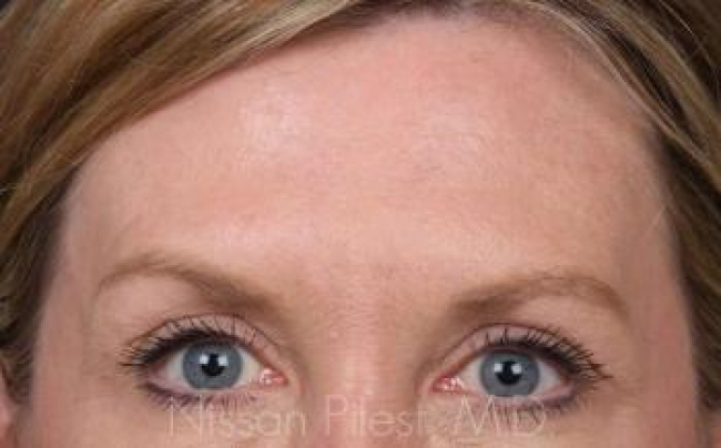 Injectables Before & After Image