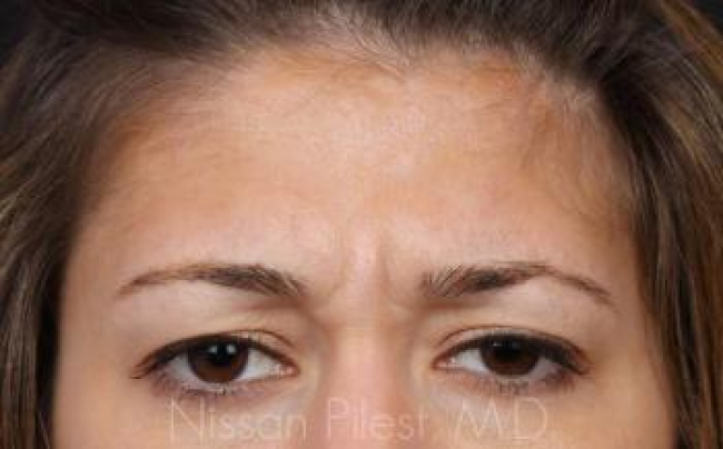 Injectables Before & After Image