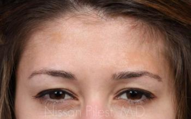 Injectables Before & After Image