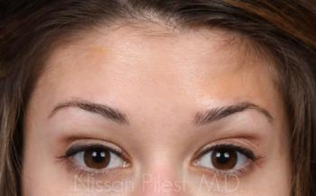 Injectables Before & After Image