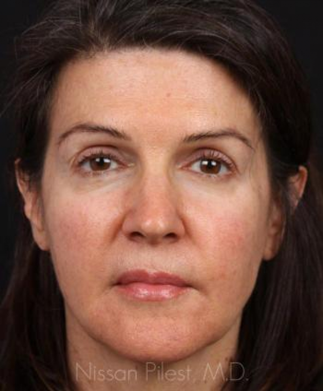 Injectables Before & After Image