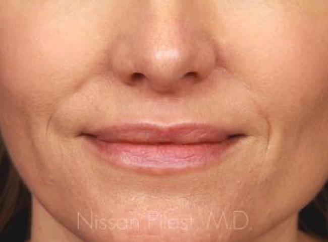 Injectables Before & After Image