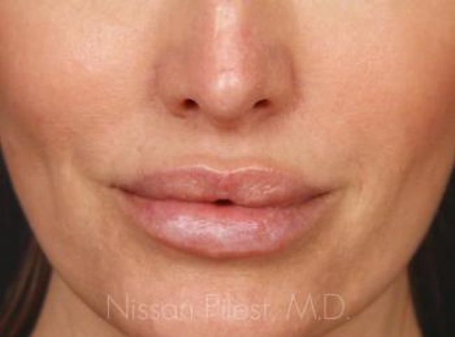 Injectables Before & After Image