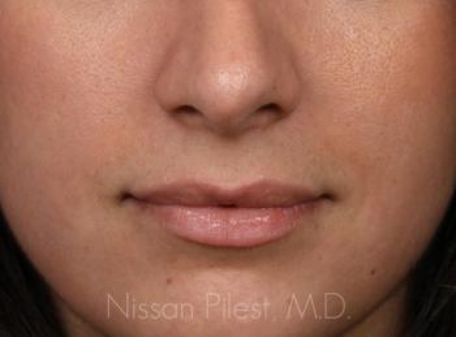 Injectables Before & After Image