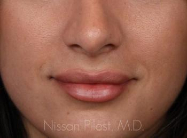 Injectables Before & After Image