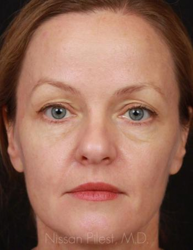 Injectables Before & After Image