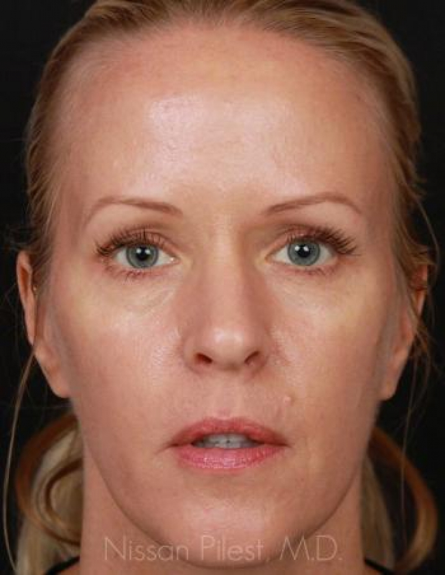 Injectables Before & After Image