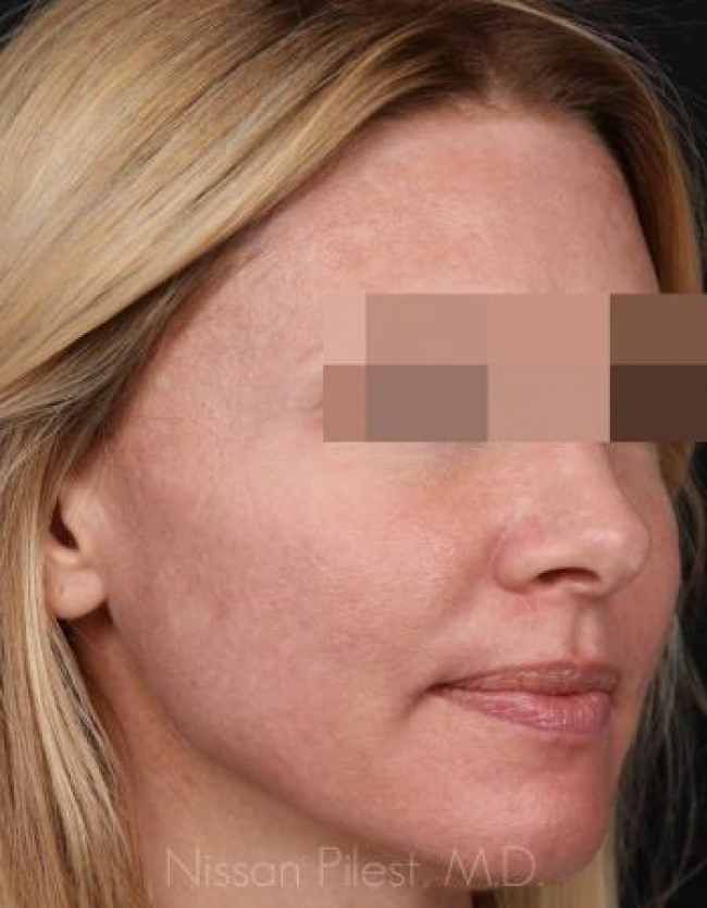 Injectables Before & After Image