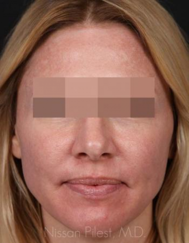 Injectables Before & After Image