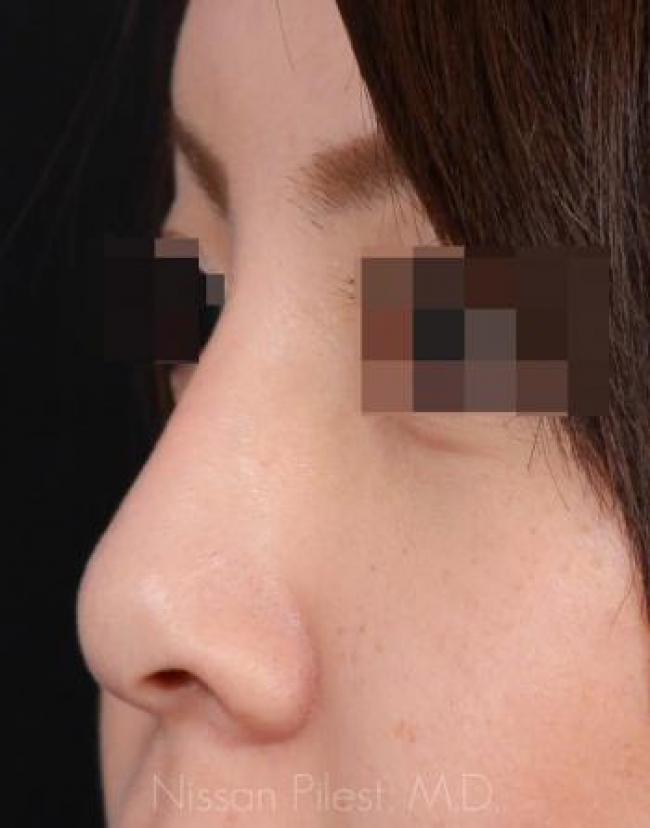 Injectables Before & After Image