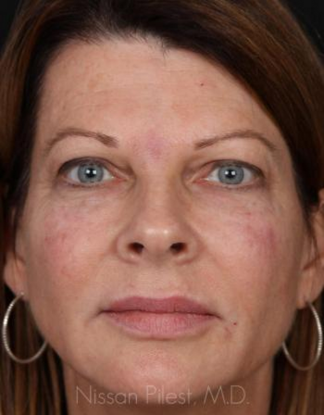 Injectables Before & After Image