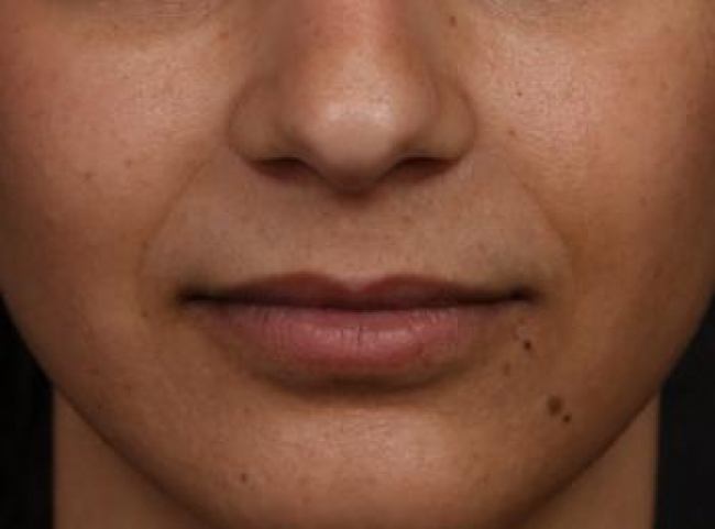 Injectables Before & After Image