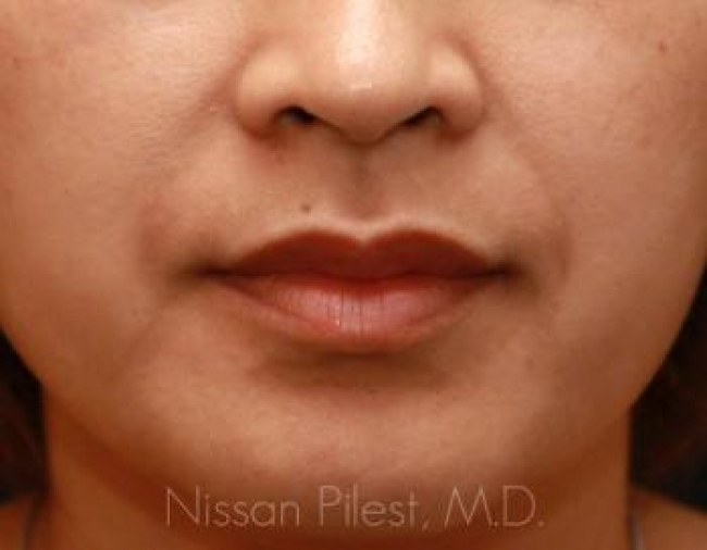 Injectables Before & After Image