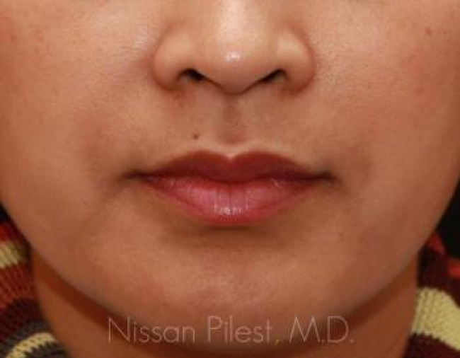 Injectables Before & After Image