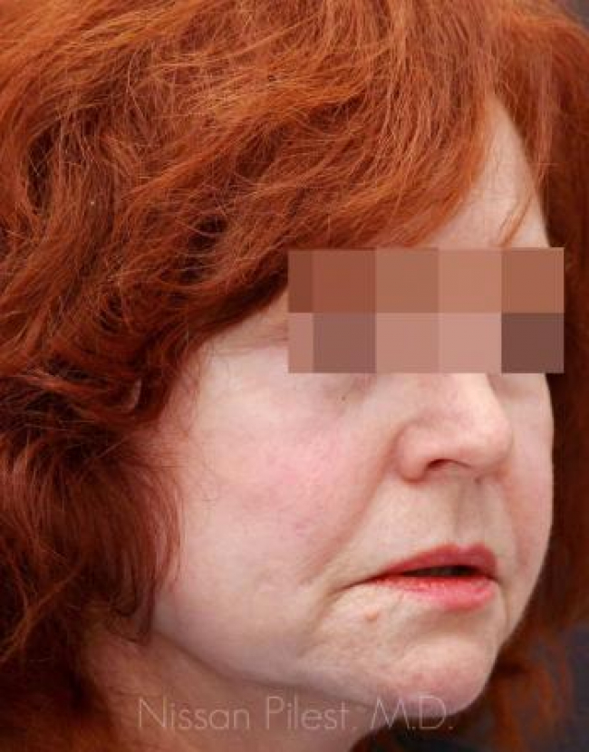 Injectables Before & After Image