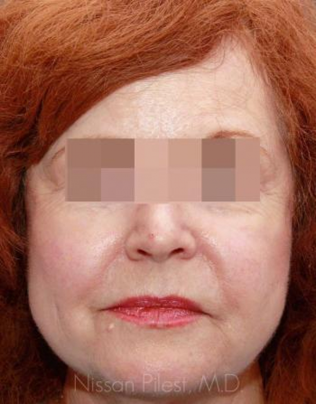 Injectables Before & After Image