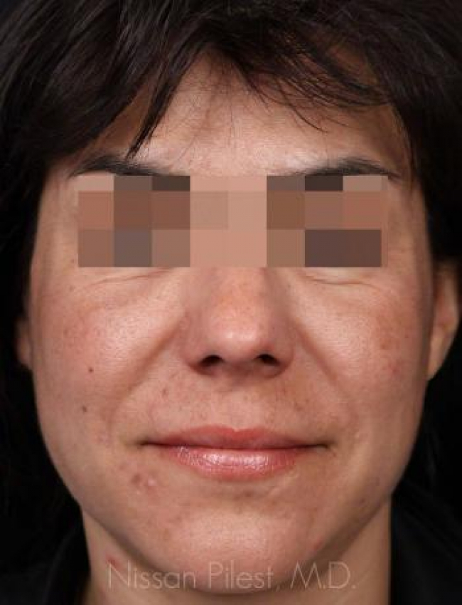 Injectables Before & After Image