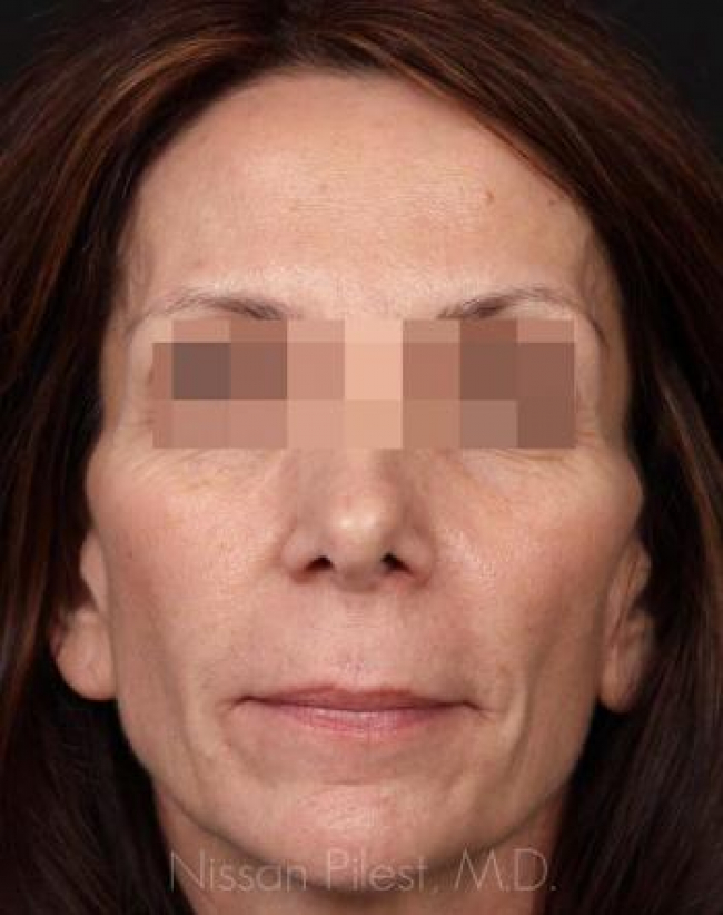 Injectables Before & After Image