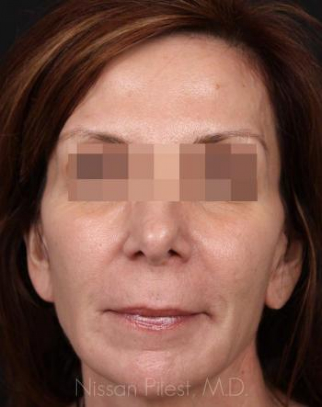 Injectables Before & After Image