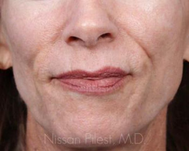 Injectables Before & After Image