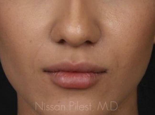 Injectables Before & After Image