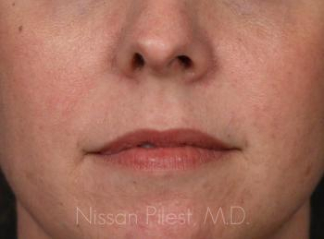 Injectables Before & After Image