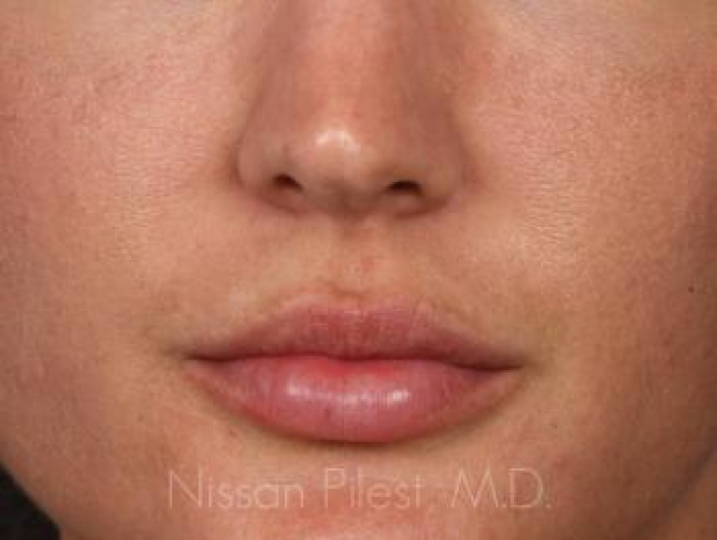 Injectables Before & After Image