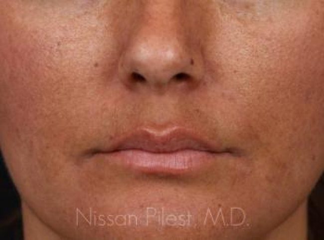 Injectables Before & After Image