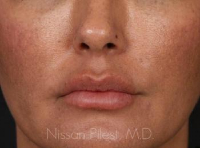 Injectables Before & After Image