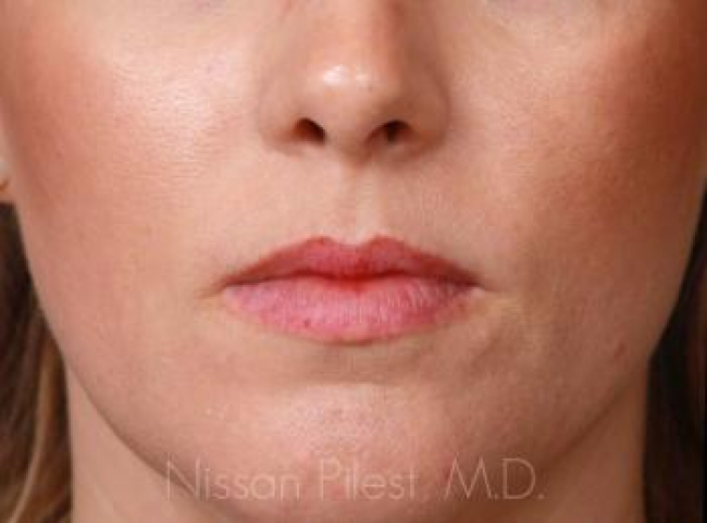 Injectables Before & After Image