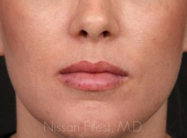 Injectables Before & After Image