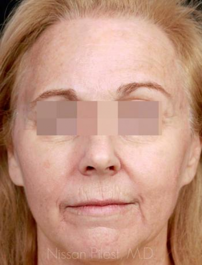 Injectables Before & After Image