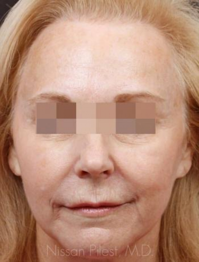 Injectables Before & After Image