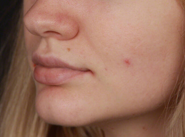 Injectables Before & After Image