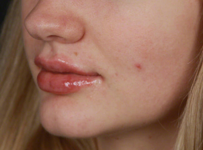 Injectables Before & After Image