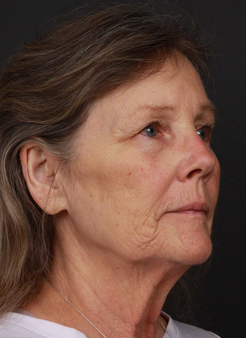 Injectables Before & After Image