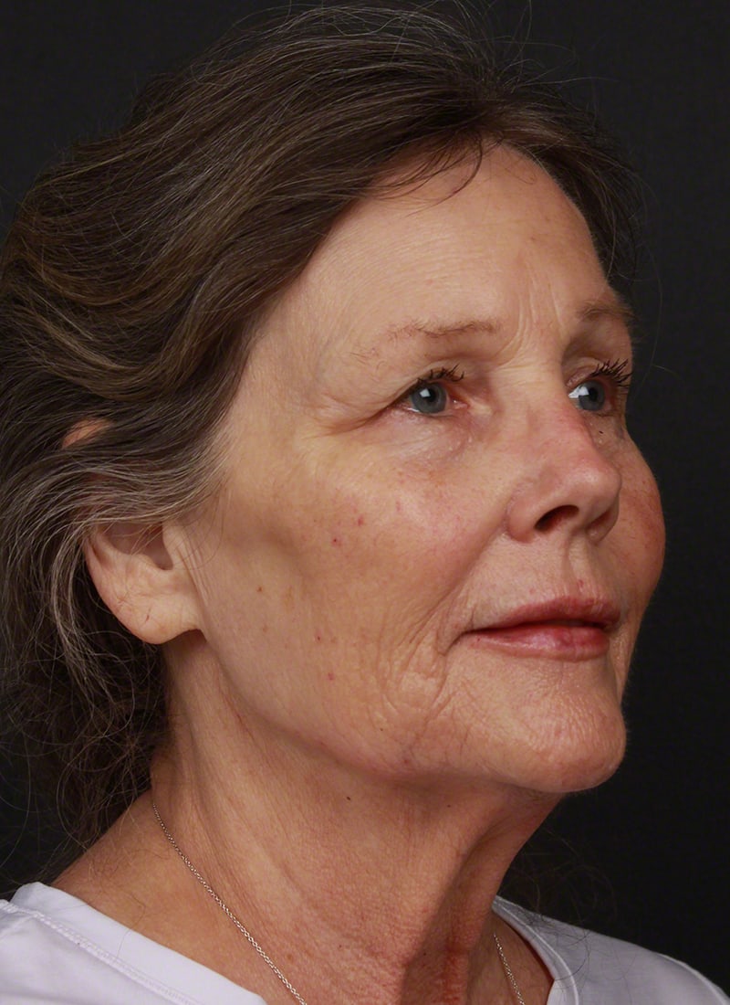 Injectables Before & After Image