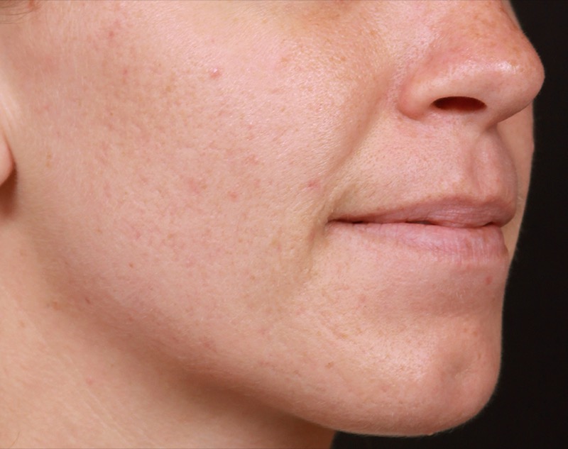 Isolaz Before & After Image