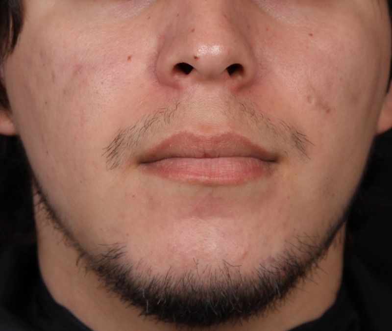 Isolaz Before & After Image